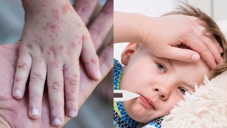 Kızamık ve boğmacaya karşı uzmanlar uyarıyor: Hadiseler artıyor, önlemleri almak gerekiyor